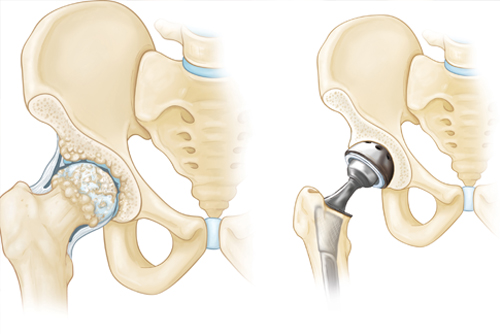 Joint Replacement Treatment in Brantford
